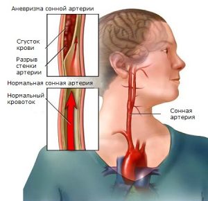 Понятие аневризмы сонной артерии