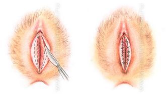операция по уменьшению размеров малых половых губ