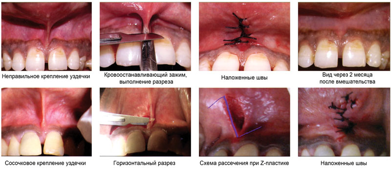 френулопластика уздечки верхней губы