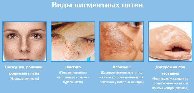 причины пигментации на коже лица