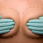 импланты для груди