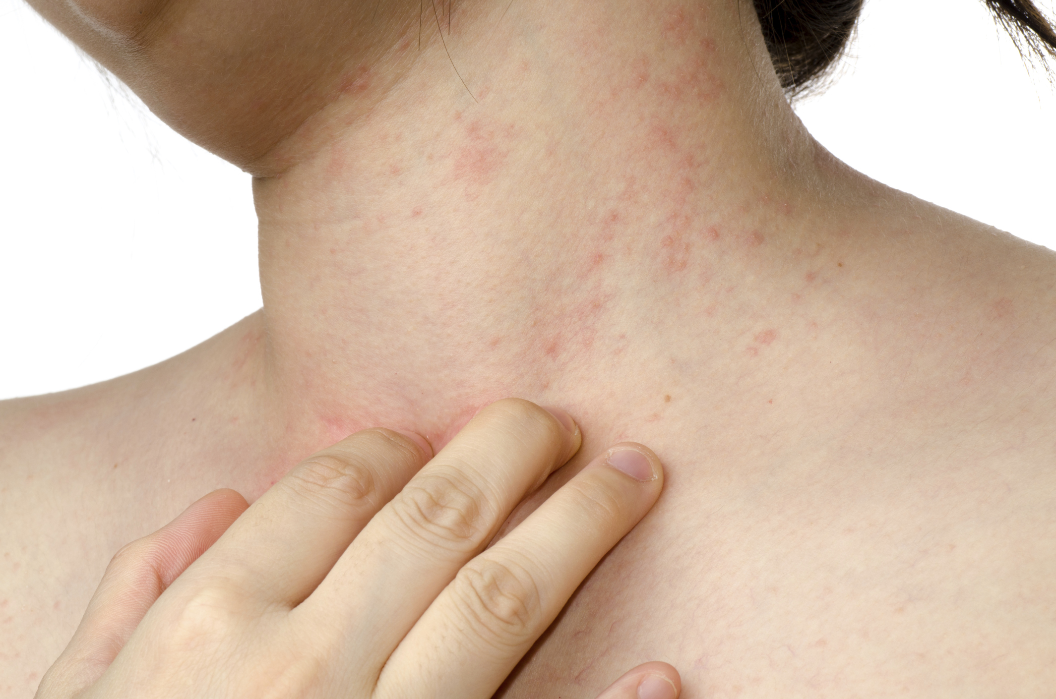 Антигистаминные мази: мази от аллергии на коже