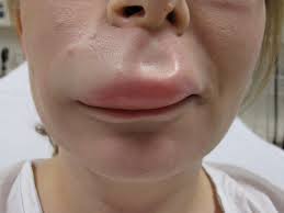 Аллергическая реакция на препарат по увеличению губ