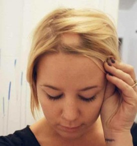 показания к криотерапии волосистой части головы