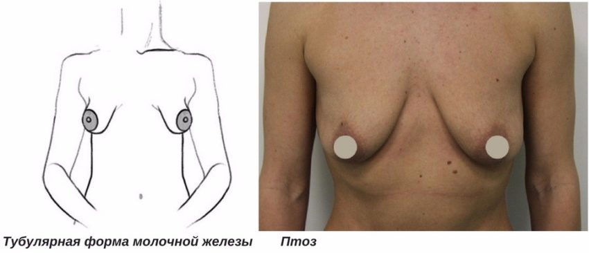 противопоказания к эндоскопическому увеличению груди