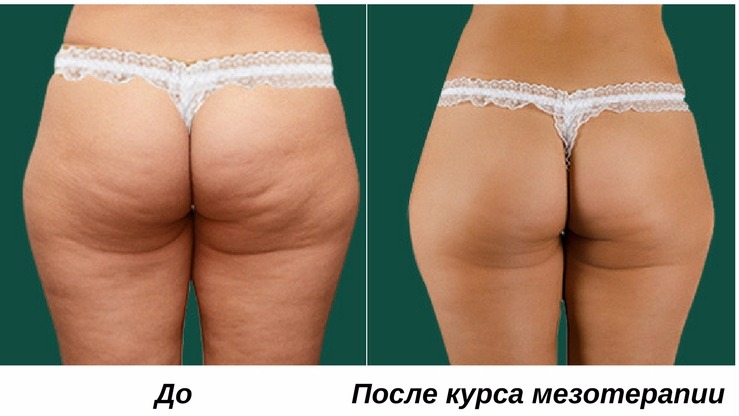 Мезотерапия тела до и после фото