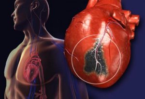 Последствия инфаркта у мужчин