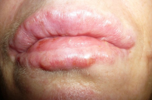 Неровности после увеличения губ