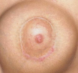 осложнения после мастопексии