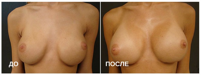 до и после увеличения груди