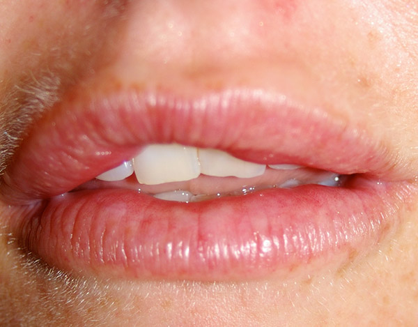 Первый биополимер. Новообразование на губе внутри. Ретенционная киста губы.