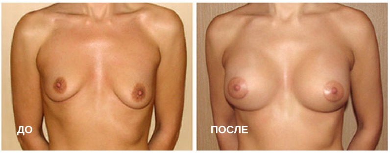 до и после пластической операции по увеличению груди