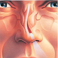 ринопластика: исправление искривленной перегородки носа
