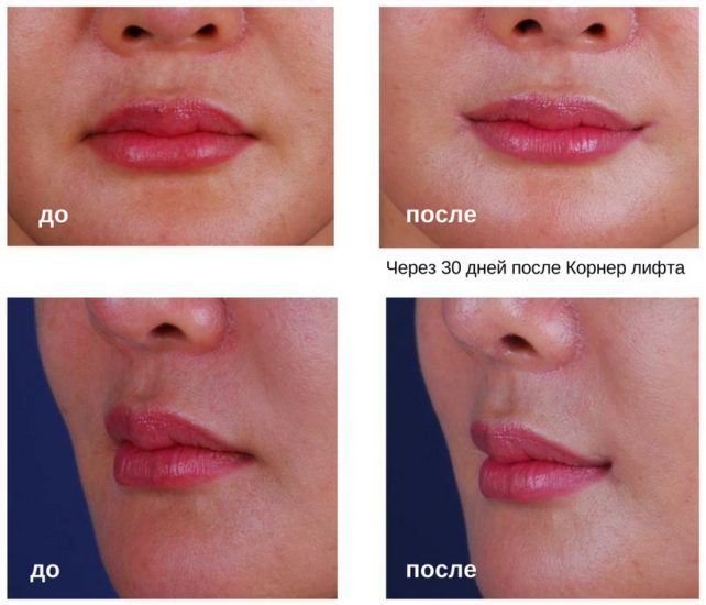 Нанонапыление губ фото до и после