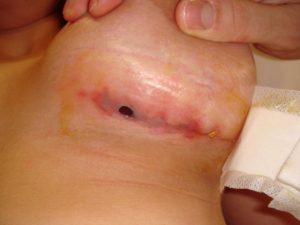 инфекция после эндопротезирования груди