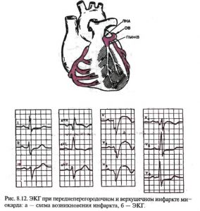 Диагностика инфаркта на ЭКГ