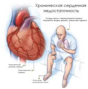 Признаки хронической сердечной недостаточности