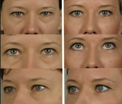 Коррекция носослезной борозды филлерами фото до и после